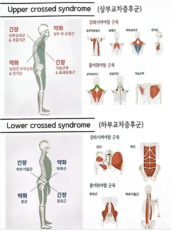 상부교차증후군과 하부교차증후군 근육 긴장과 약화 패턴
